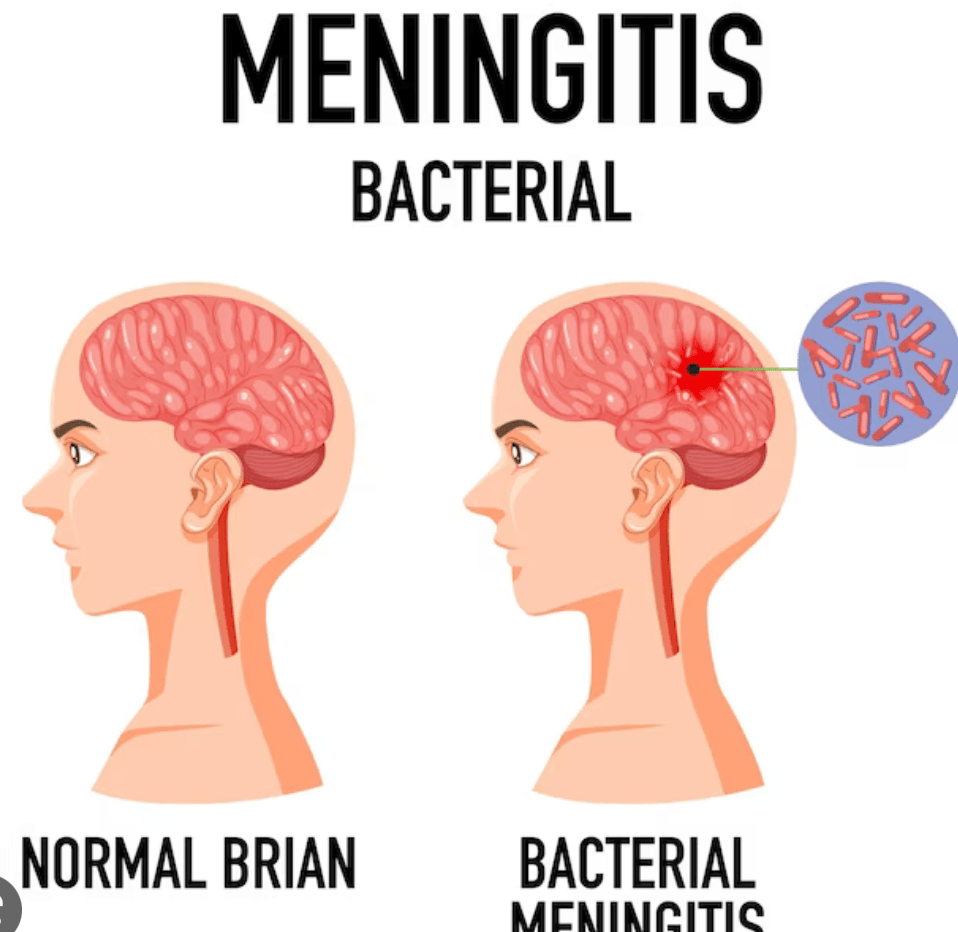Meningitis kills 118 persons in 22 states of Nigeria