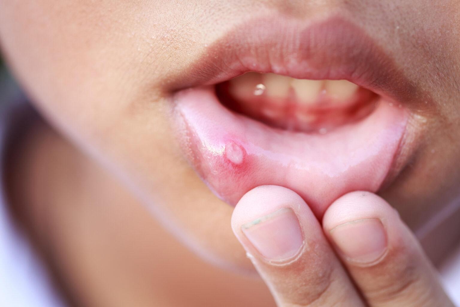5 Home Remedies for Mouth Ulcers